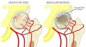 Hoại tử chỏm xương đùi