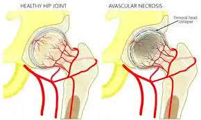 Hoại tử chỏm xương đùi