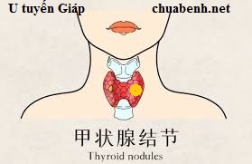 Hiểu đúng về Nhân Tuyến Giáp