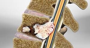 Ung thư cột sống thứ phát