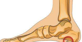 Gai gót chân: Nguyên nhân, triệu chứng, chẩn đoán