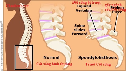 Trượt Cột sống và Cột sống bình thường