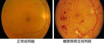 Bài thuốc nổi tiếng của Trung Quốc để chữa trị giảm thị lực ở người Đái tháo Đường