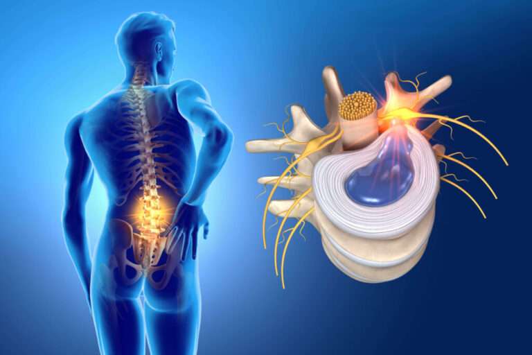 Những Biến Chứng Nguy Hiểm Của Thoát Vị Đĩa Đệm Cột Sống Thắt Lưng Nếu Không Điều Trị Sớm Những Biến Chứng Nguy Hiểm Của Thoát Vị Đĩa Đệm Cột Sống Thắt Lưng Nếu Không Điều Trị Sớm
