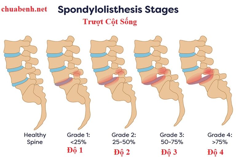 Trượt Cột sống thắt Lưng