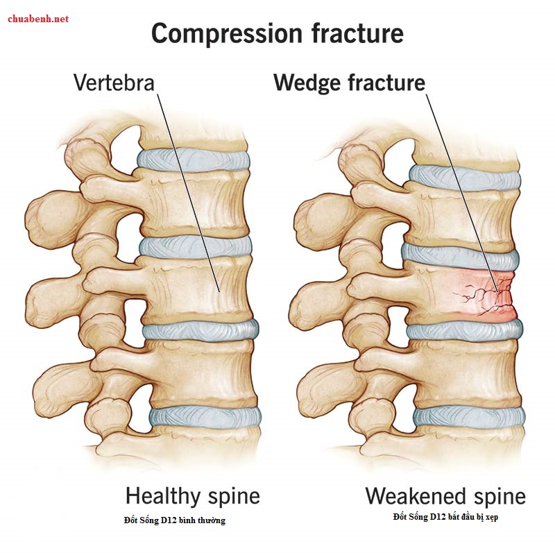 Hình ảnh xẹp Đốt sống D12