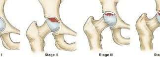 Phân loại mức độ bệnh của bệnh hoại tử Chỏm Xương Đùi?