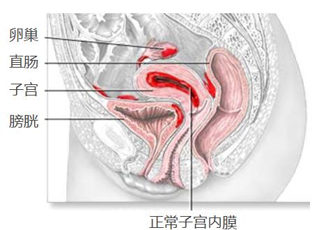 Đông Y có chữa lạc nội mạc tử cung gây vô sinh được không?