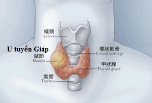  Khi phát hiện thấy U Tuyến Giáp Tôi nên làm gì?