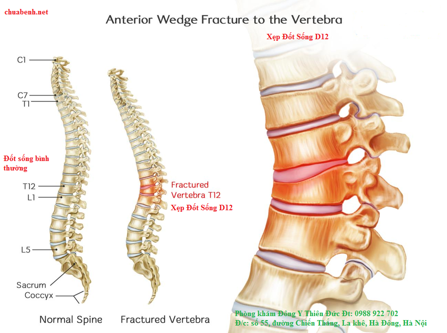 Hình ảnh xẹp Đốt sống D12
