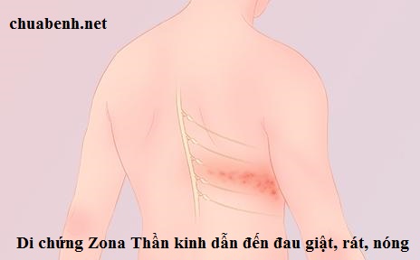 Di chứng Zona thần kinh