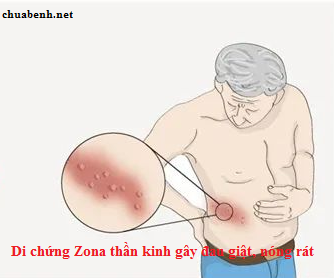 Bị Di Chứng Zona Thần Kinh