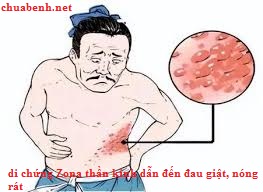 Di chứng Zona thần kinh