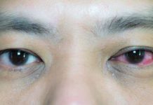 Kinh nghiệm điều trị mắt đỏ sưng đau, viêm kết mạc cấp tính