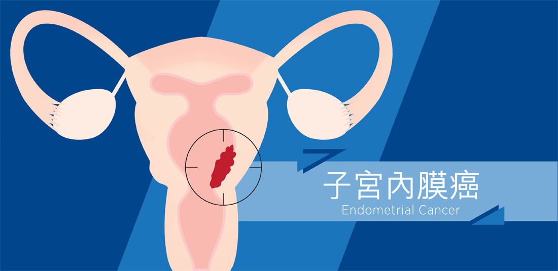 Đông Y có chữa lạc nội mạc tử cung gây vô sinh được không?