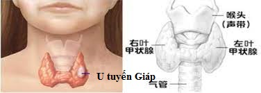  Khi phát hiện thấy U Tuyến Giáp Tôi nên làm gì?