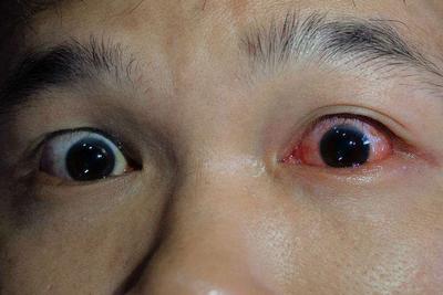 Kinh nghiệm điều trị mắt đỏ sưng đau, viêm kết mạc cấp tính