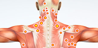 châm cứu điểm kích hoạt