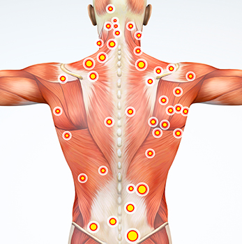 châm cứu điểm kích hoạt