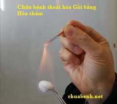 Chữa bệnh thoái hóa Gối bằng Hỏa châm