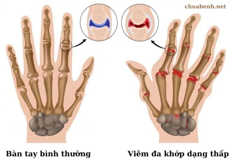 Những biến chứng của viêm đa khớp dạng thấp nếu điều trị không đúng là gì? Những biến chứng của viêm đa khớp dạng thấp nếu điều trị không đúng là gì?