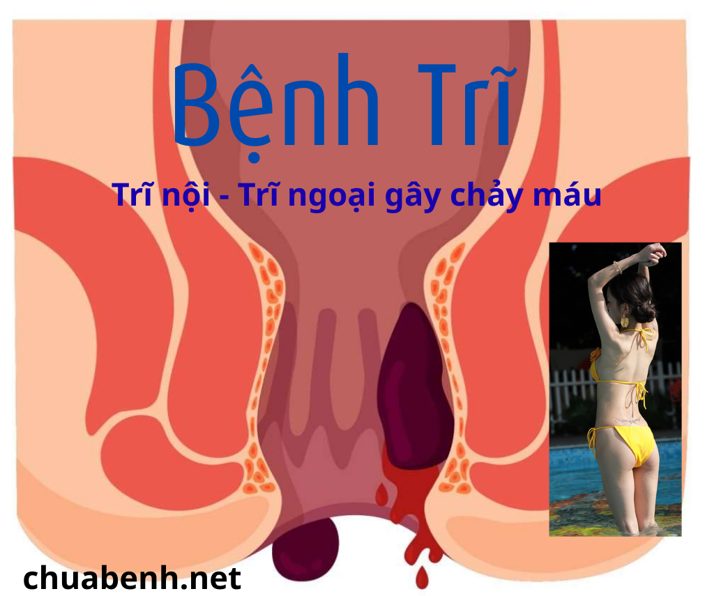 Bệnh Trĩ