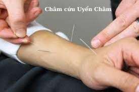 Châm cứu Uyển Châm