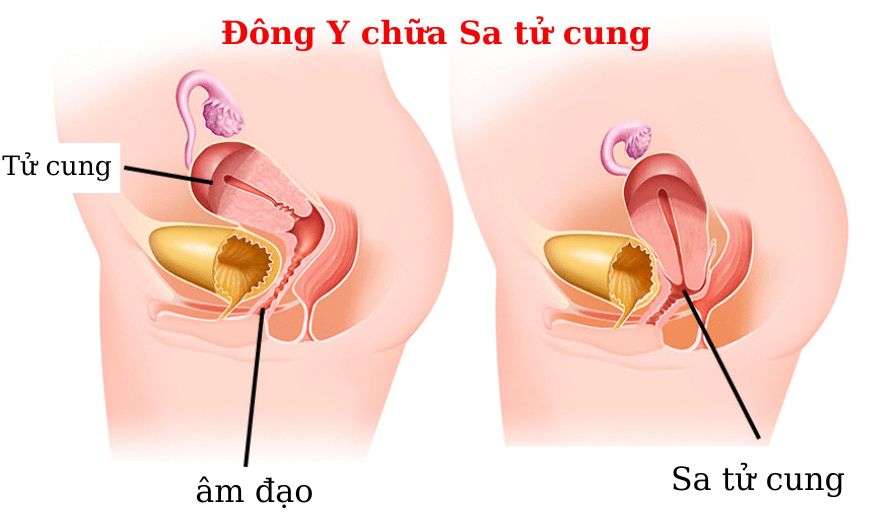 Tử cung bình thường