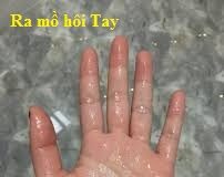Ra mồ hôi Tay