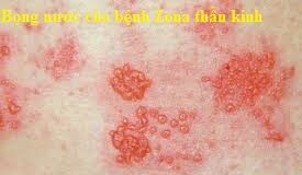 Di chứng Zona thần kinh có chữa được khỏi không?