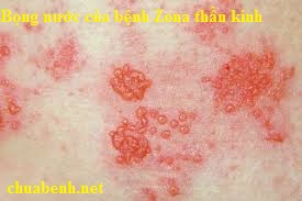 Di chứng Zona thần kinh có chữa được khỏi không?