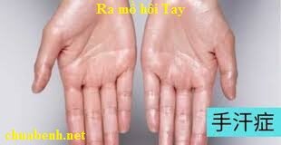 Ra mồ hôi Tay