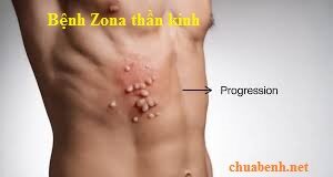 Bệnh Zona thần kinh