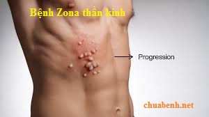 Bệnh Zona thần kinh