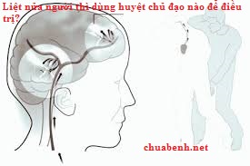 Liệt nửa người thì dùng huyệt chủ đạo nào để điều trị?