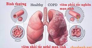 Viêm Phổi Tắc Nghẽn Mạn Tính