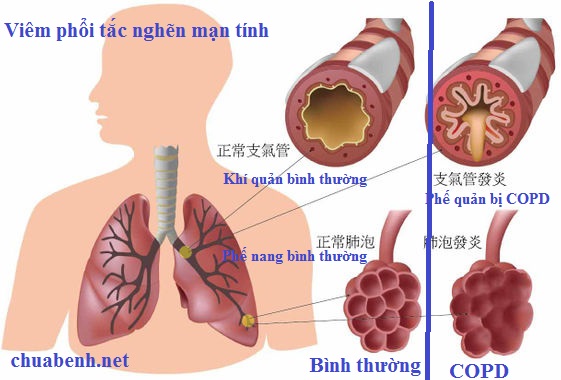Viêm Phổi Tắc Nghẽn Mạn Tính