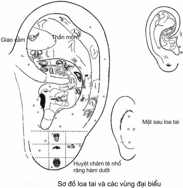 nhĩ châm và các vùng trên loa tai