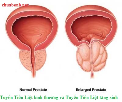Tiền Liệt Tuyến theo Trung Y