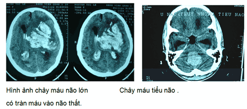 Hình ảnh chảy máu não lớn, Chảy máu tiểu não có tràn máu vào não thất.
