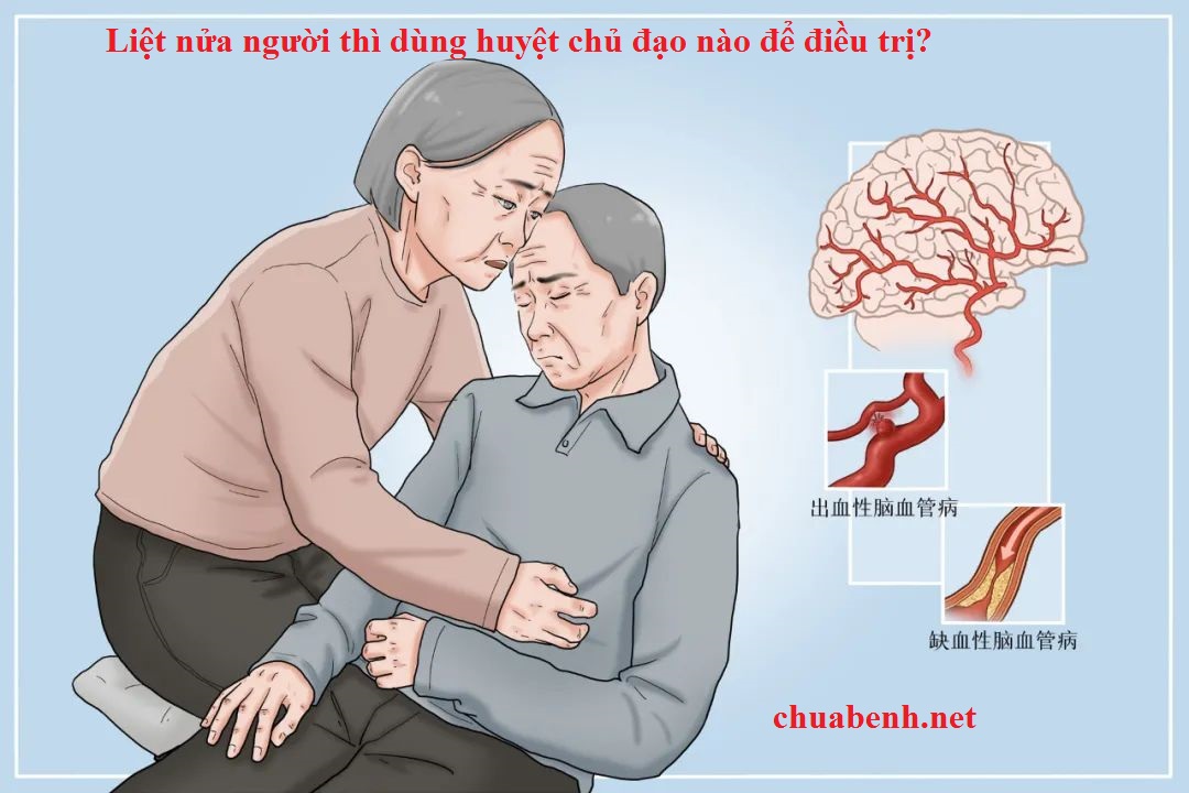 Liệt nửa người thì dùng huyệt chủ đạo nào để điều trị?