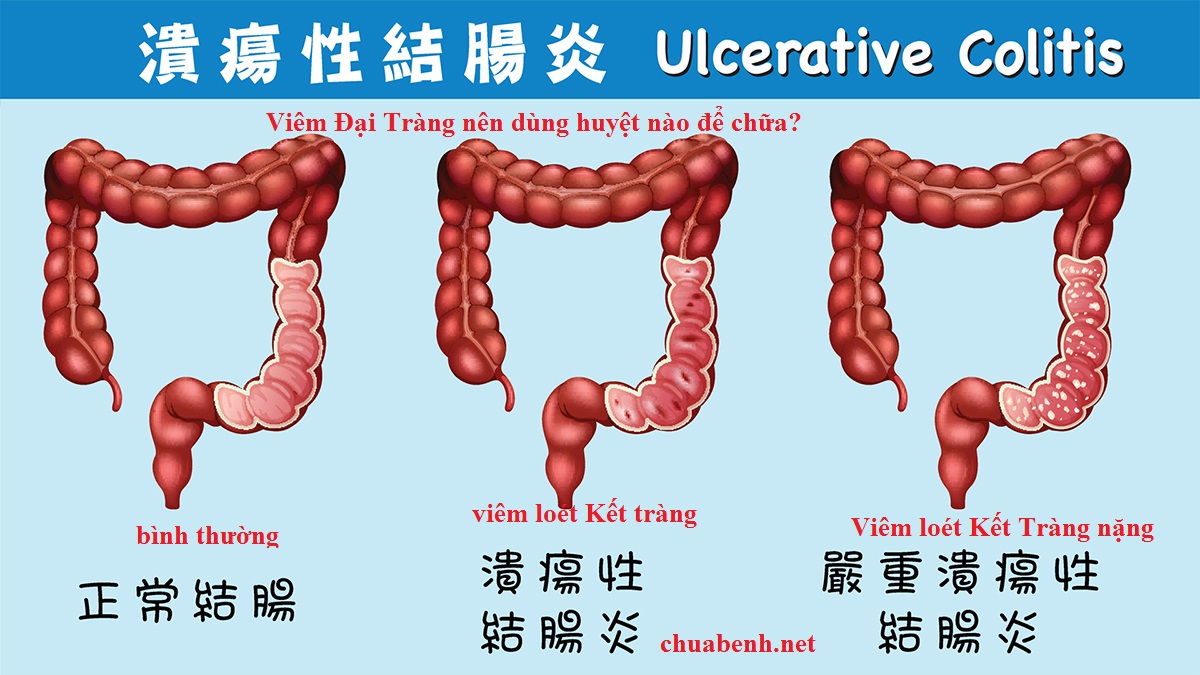 Viêm Đại Tràng nên dùng huyệt nào để chữa?