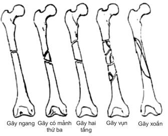 duong-gay-than-xuong-dui