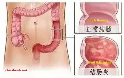 Viêm Đại Tràng nên dùng huyệt nào để chữa?