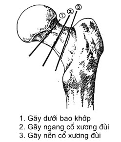 gay-co-xuong-dui-theo-delbe