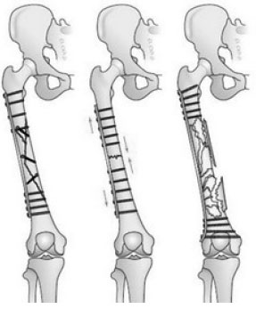 kết hợp xương nẹp vít trong gay thân xương đùi