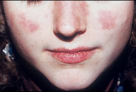 hình ảnh bệnh lupus ban đỏ hệ thống