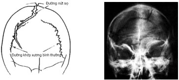 phim x quang nứt sọ não trong chấn thương sọ não kín