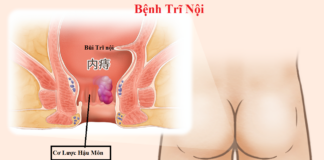 Bệnh Trĩ nội