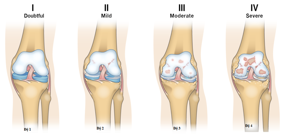 Phân độ thoái hóa khớp Gối